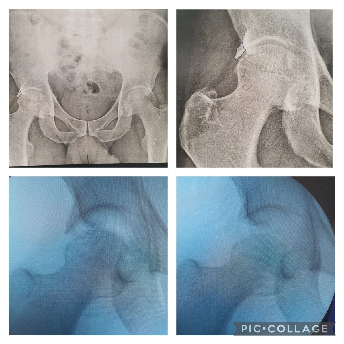 Correção de Impacto Femoroacetabular grave com reconstrução labial
