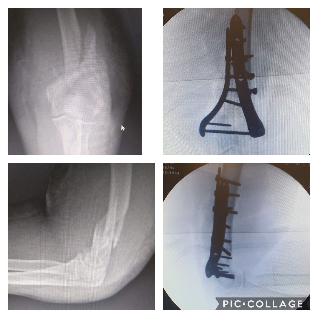 Fratura articulares complexas