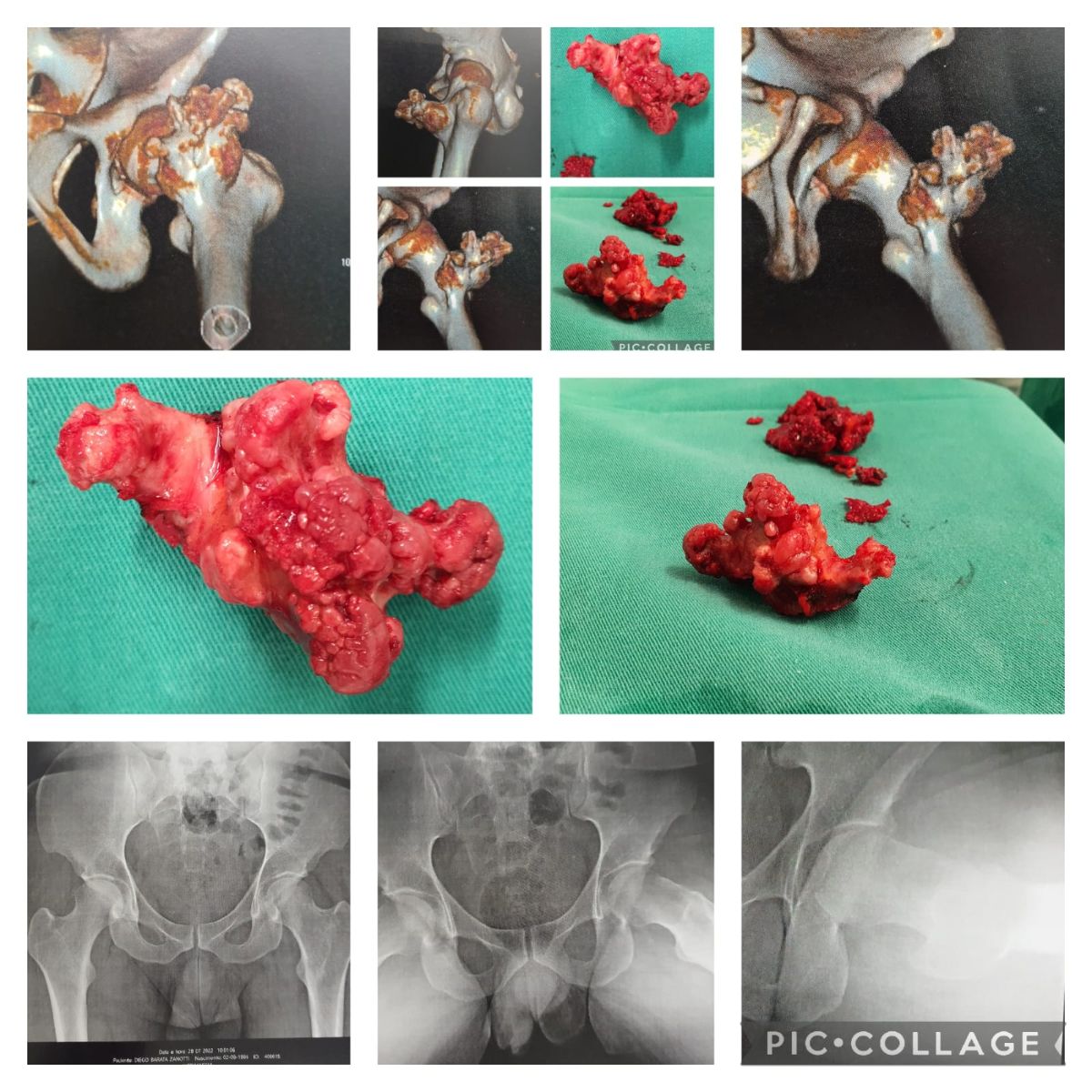 Osteocondroma Femoral Gigante