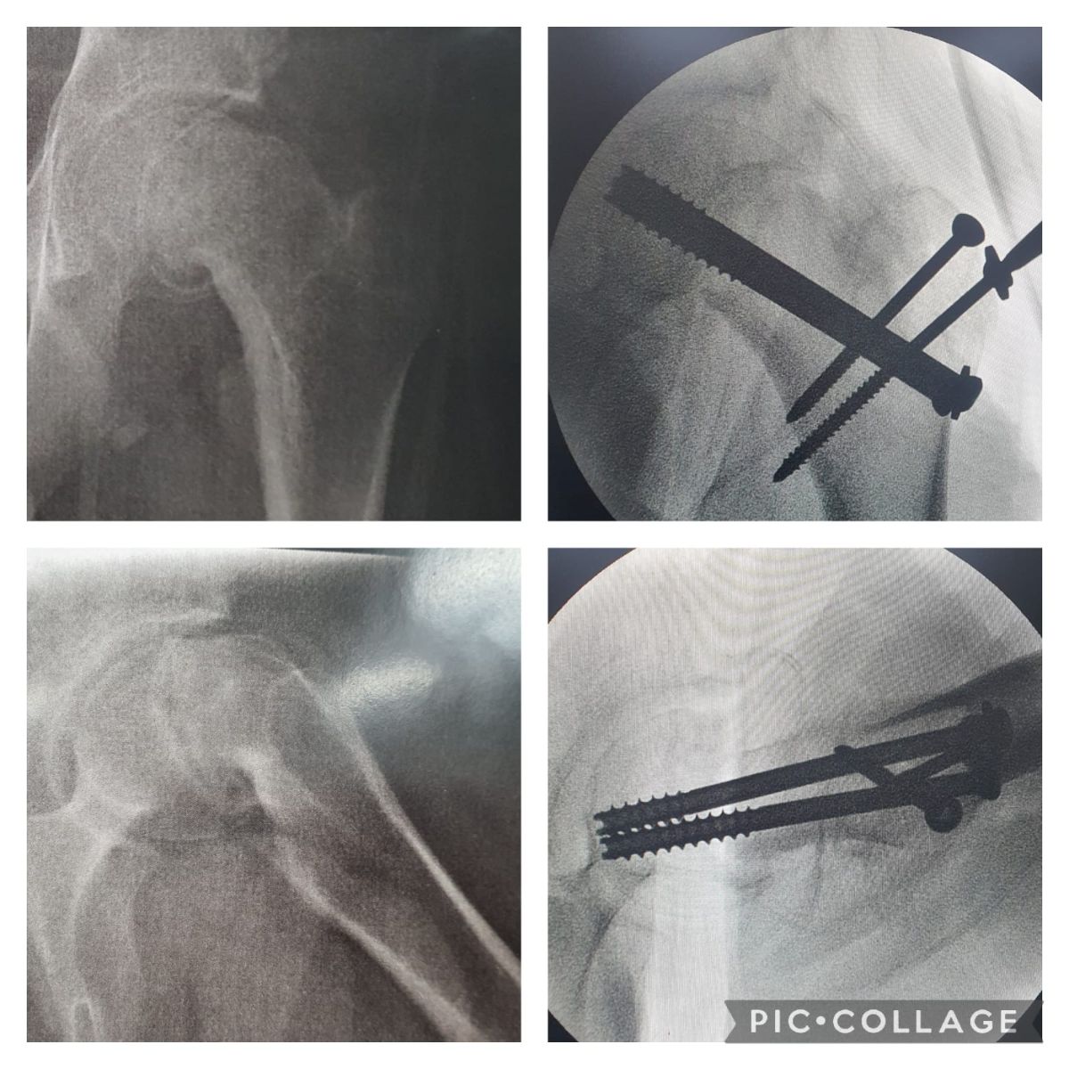 Osteotomia de Dunn modificada (pelo acesso de Ganz)