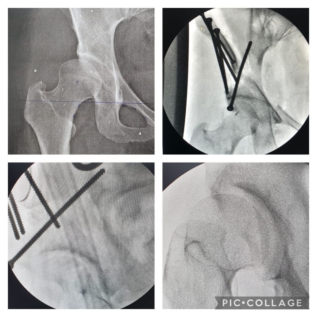 Osteotomia Periacetabular de Ganz