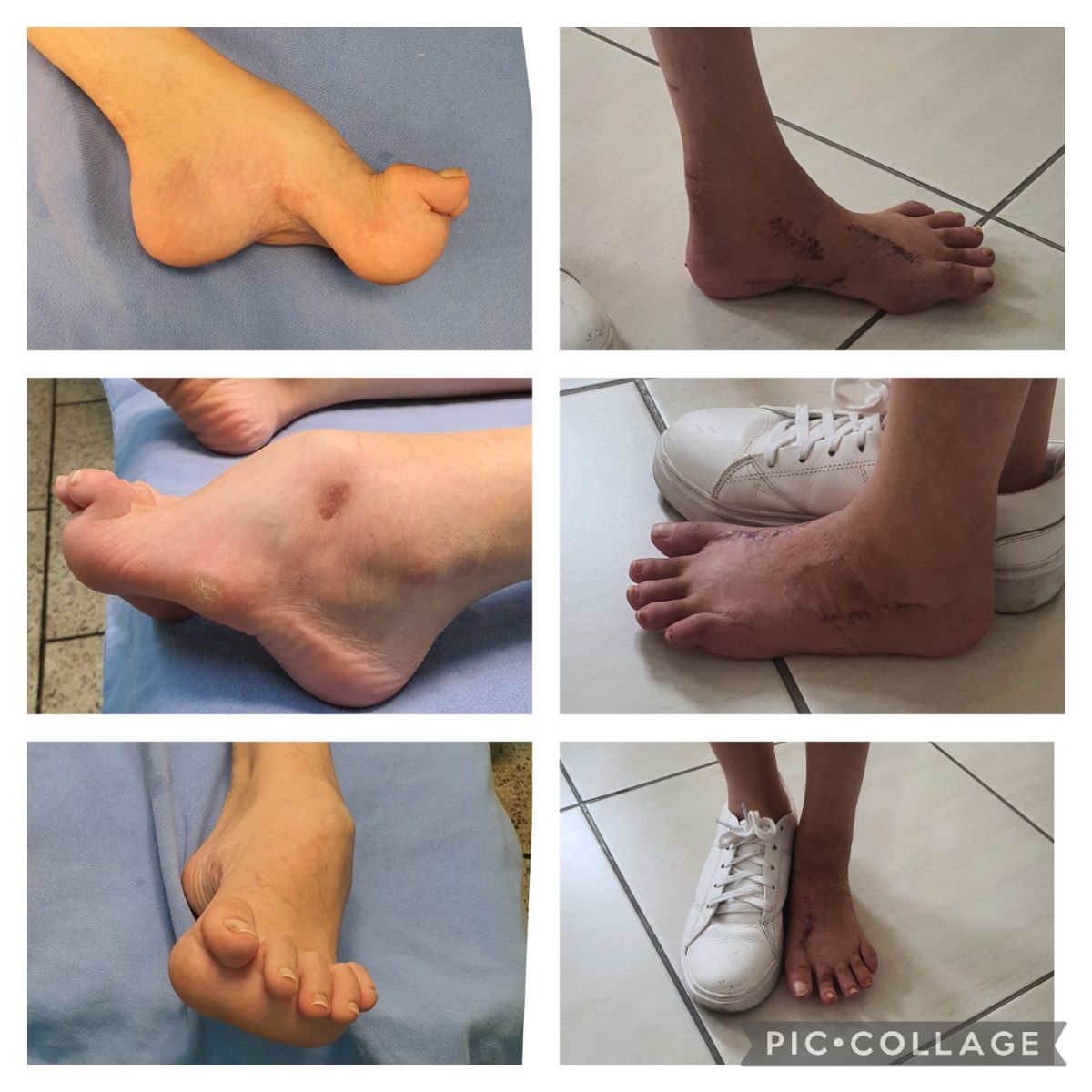 Pé cavo em Síndrome da Medula Prese