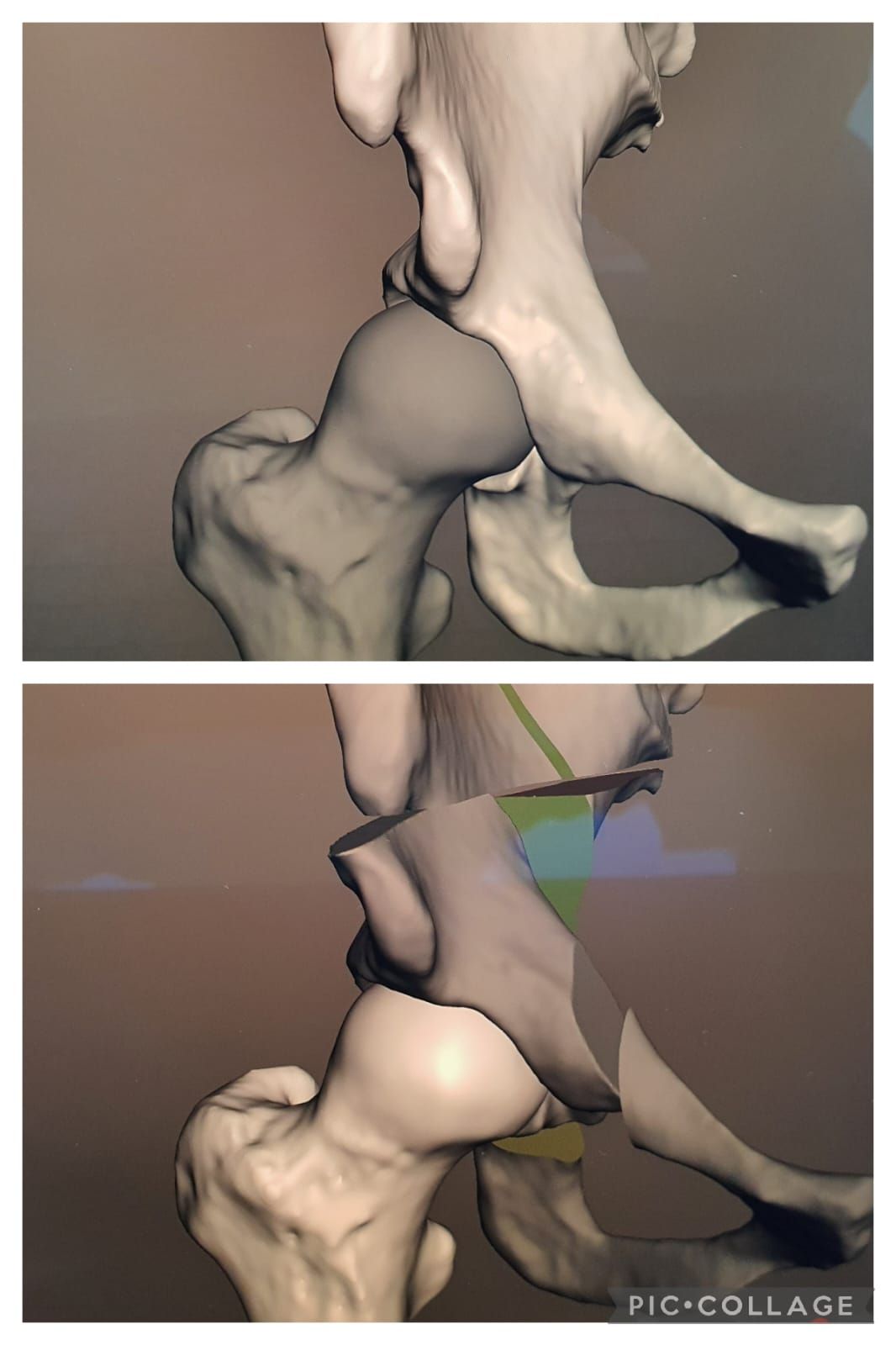 Planejamento Cirurgico Digital 3D da Osteotomia Periacetabular